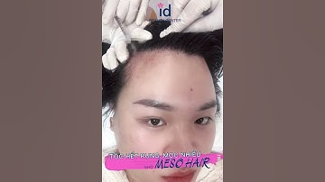 TÓC HẾT RỤNG, MỌC NHIỀU NHỜ MESO HAIR | id