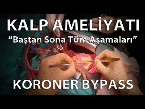 Kalp Ameliyatı (Koroner Bypass ın Tüm Aşamaları)