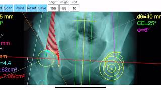 How to do from simple X-Ray with the HipBiomechanicsApp complex hip biomechanic studies -tutorial-