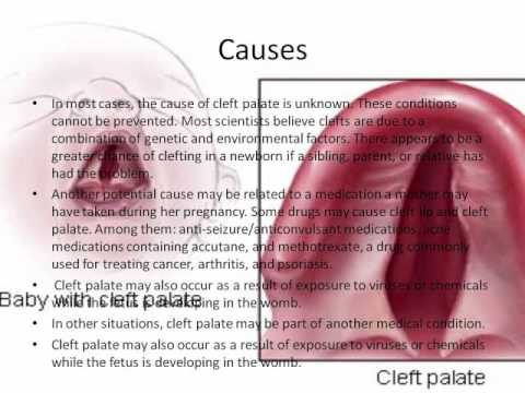CLEFT PALATE- genetic disorder - YouTube