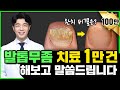 발톱무좀 치료 1만번 해본 피부과전문의가 말합니다 (발톱무좀약, 발톱무좀레이저, 발톱무좀제거)