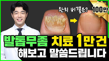 발톱무좀 치료 1만번 해본 피부과전문의가 말합니다 (발톱무좀약, 발톱무좀레이저, 발톱무좀제거)