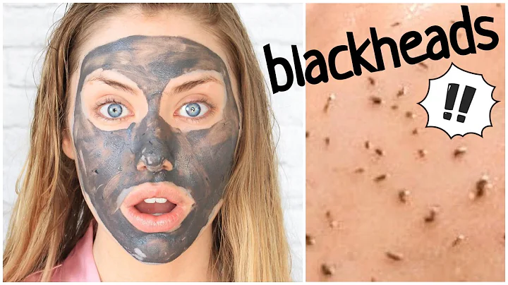 SKIN GRITTING // CRAZY Blackhead Removal Method!