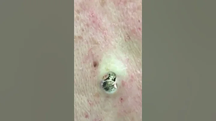 MASSIVE Blackhead Popped Out!! #DrPimplePopperThisIsZit #Shorts