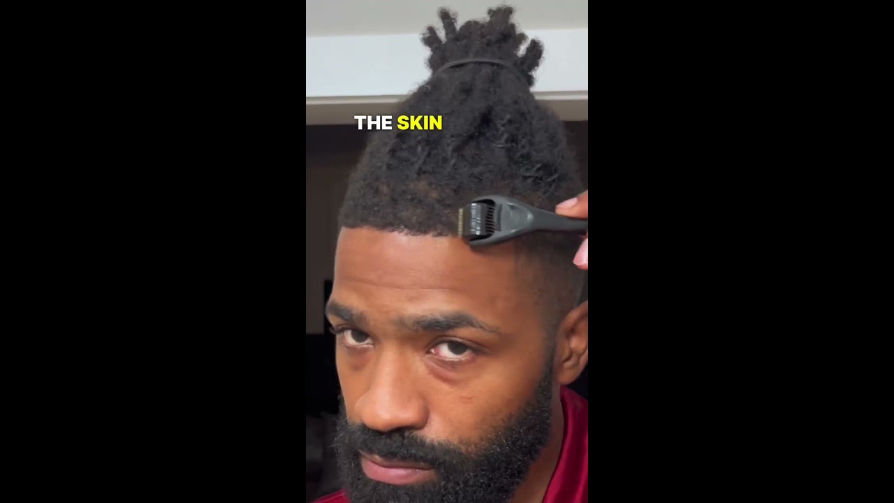 But Does It Work On Your Temples Dermaroller Hairloss Hairlosstreatment