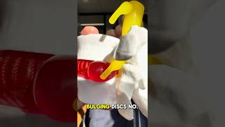 3 things you didn’t know about bulging discs