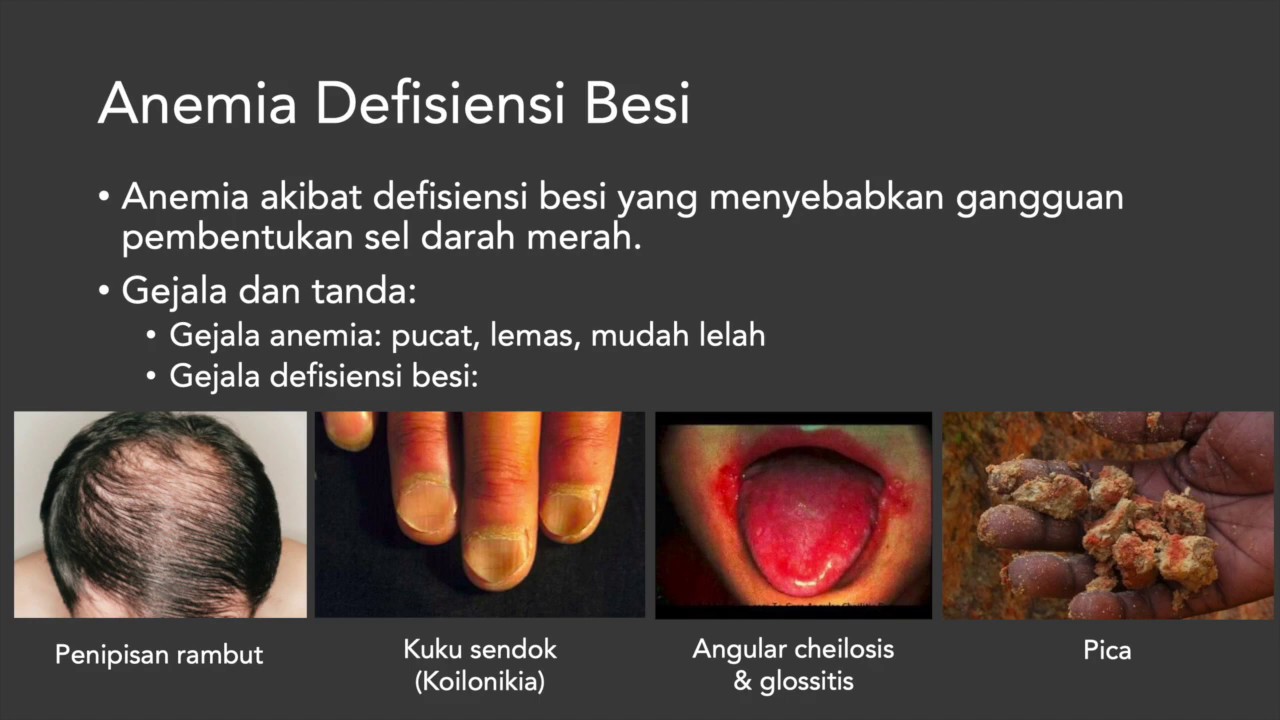 Anemia - Diagnosis, Penyebab Anemia