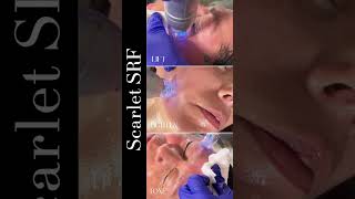 Scarlet SRF