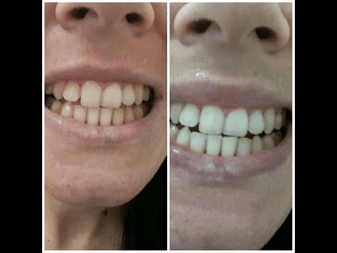 Clareamento dental caseiro com carvao