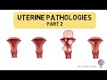 Uterine pathologies part 2