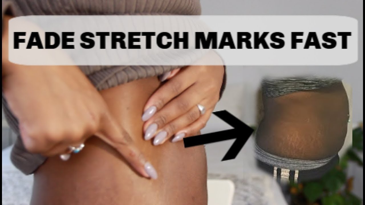 How To Improve Stretch Marks Loose Skin Chay Andrea Youtube