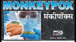 Monkeypox Goes Global: Outbreak in Non-endemic Countries