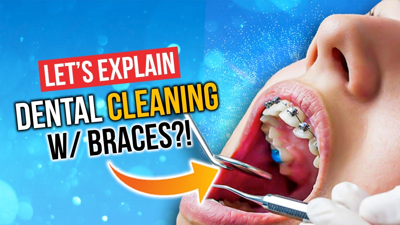 Dental CLEANING With BRACES! YouTube