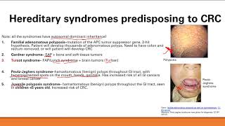 Colorectal Cancer Gi System Step 1 Simplified