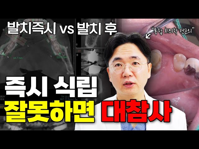 발치즉시 임플란트와 발치 후 임플란트, 어떤 게 더 좋을까?