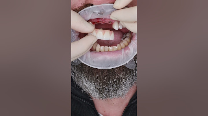 Dental implant’s  in Prague #shorts #dentist #dental #implant #veneers #short