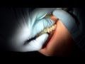 dental,how to pull fully impacted wisdom tooth 17/28 (part 4).
