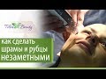 Удаление шрамов и рубцов. 🗡 Как сегодня удаляют шрамы и рубцы. Telo's Beauty