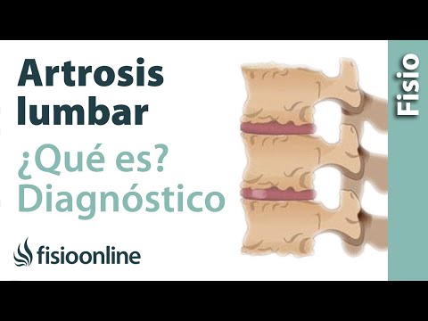 Artrosis lumbar - Qué es y cómo se diagnostica en radiografías