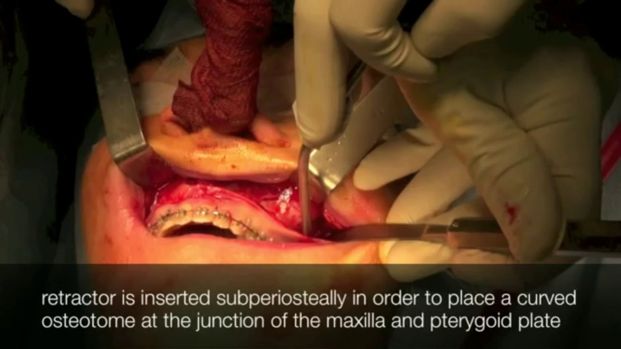lefort osteotomies