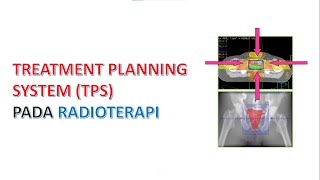 Radioterapi 6: TREATMENT PLANNING PADA RADIOTERAPI