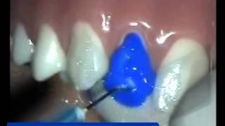 Porcelain Veneer 2/2 Cementation