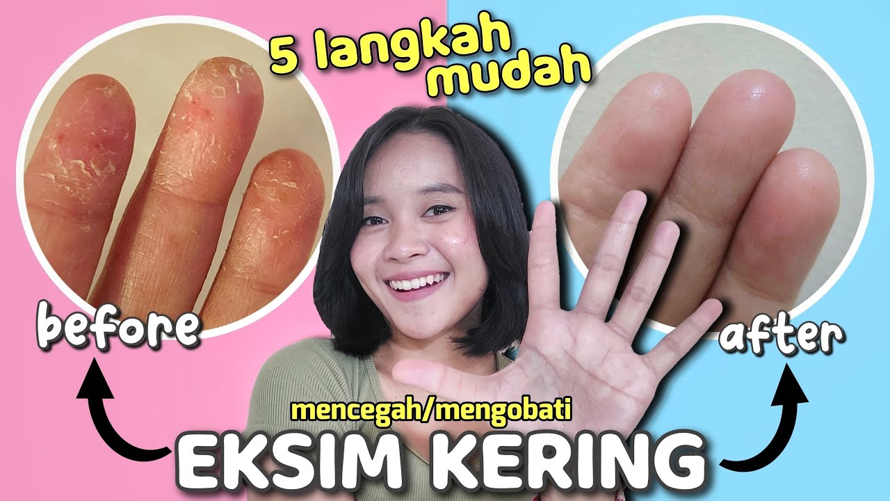 CARA MENGOBATI atau MENCEGAH KULIT EKSIM! GATAL MINTA AMPUN!! YouTube