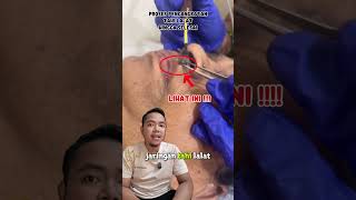 Tahi Lalat Dilaser? Belum Tentu! Ini Sebenarnya Kauterisasi #dryo