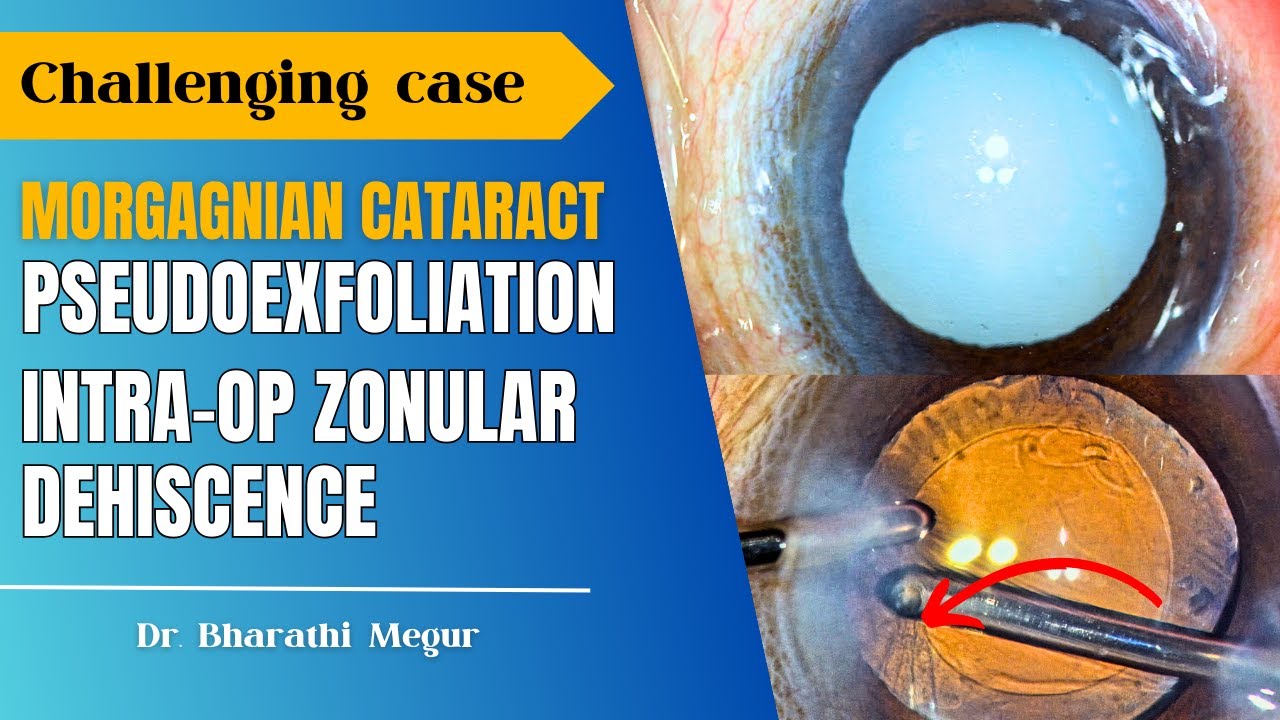 Challenging case cataract, PXF & Intraop Zonular