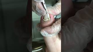 Extreme Pedicure: Stubborn Ingrown Toenail Is So Hard to Remove #Shorts #duet #satisfying #relax