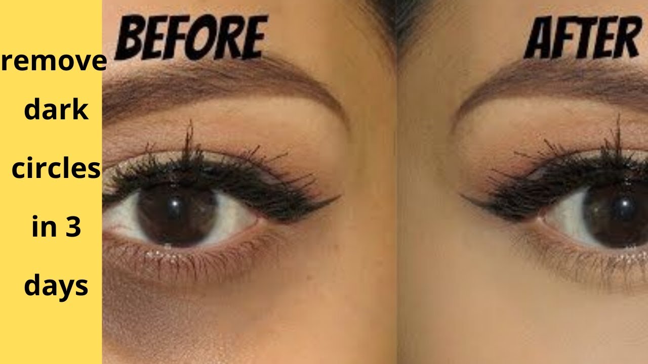 remove black circles under eyes home remedy