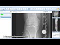 Osteotomie with mediCAD - предоперационное планирование