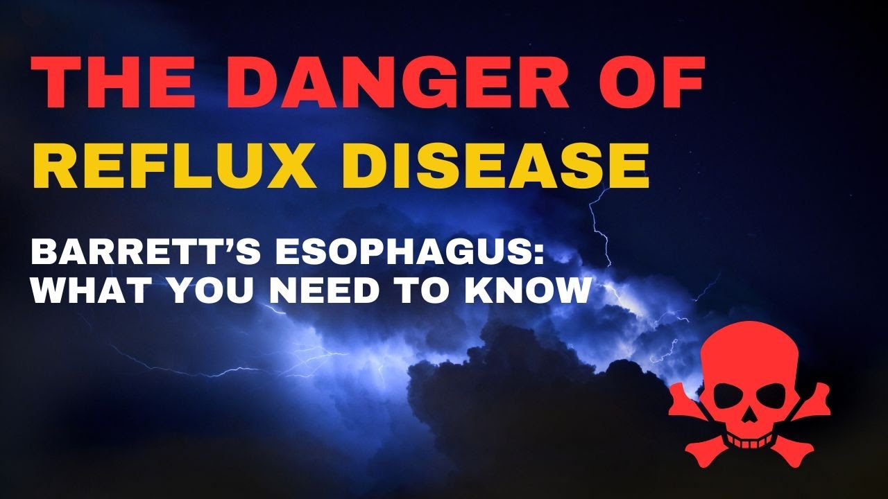 GERD Gastro Esophageal Reflux Disease Barrett's Esophagus Cancer
