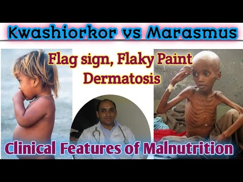 a and b a Severe wasting b Marasmus with gluteal skin folds   Download Scientific Diagram