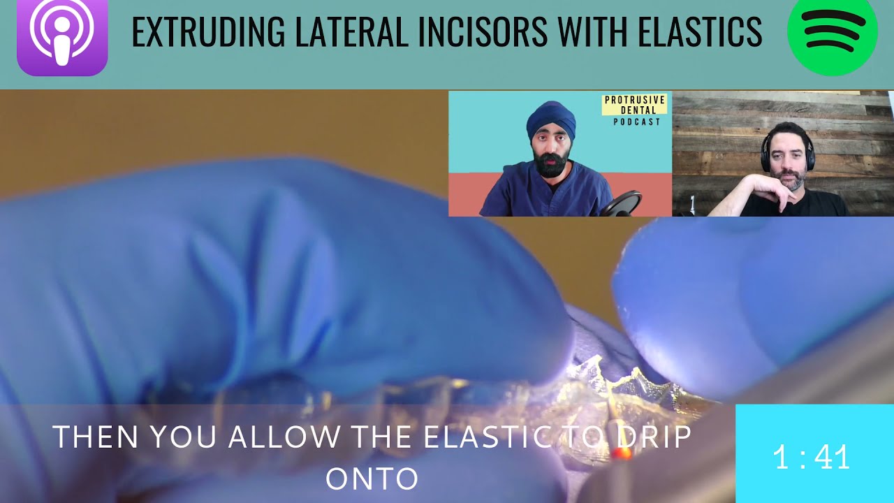 Как выдвинуть боковые резцы с помощью эластиков во время использования прозрачных элайнеров (Invi...