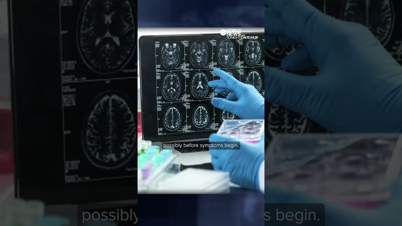 Study finds new blood test could screen for Alzheimer’s