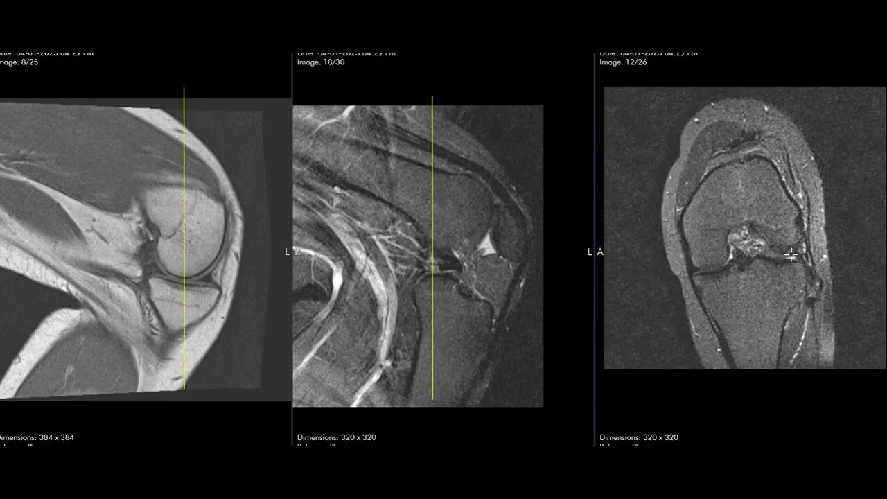 Dislocated Meniscus And Knee Locked In Flexion YouTube Dislocated Meniscus And Knee Locked In Flexion YouTube