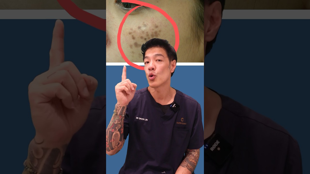 What is this skin condition? | Hori's Naevus #skincaretips