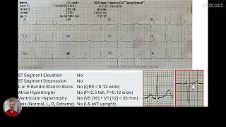Chapter 11 - 12 Lead Analysis Example