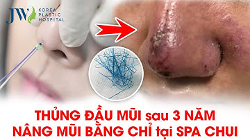 Bác sĩ Tú Dung PHƠI BÀY thủ đoạn NÂNG MŨI CHỈ của SPA CHUI khiến Cô gái THỦNG MŨI sau 3 NĂM