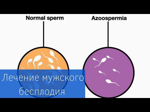 МУЖСКОЕ БЕСПЛОДИЕ | Азооспермия: диагностика и лечение