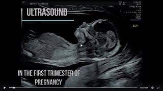 Diagnostic Ultrasound in the First Trimester -  scanning basics \& new screening modalities