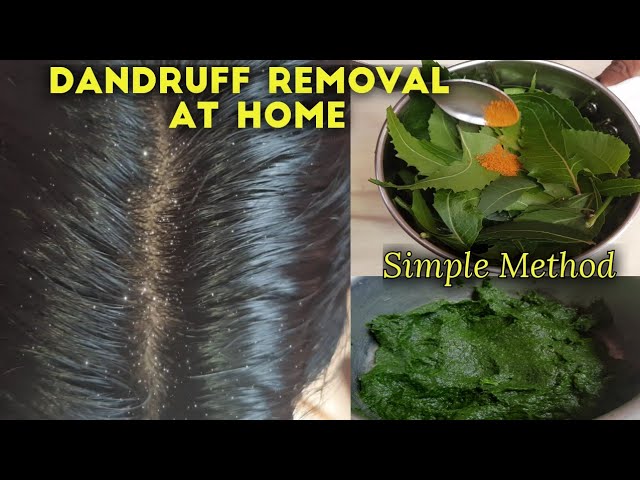 Dandruff Treatment At Home Tamil | Home Remedy For Dandruff Tamil |பொடுகு  தொல்லை தீர #Haircaretips - YouTube