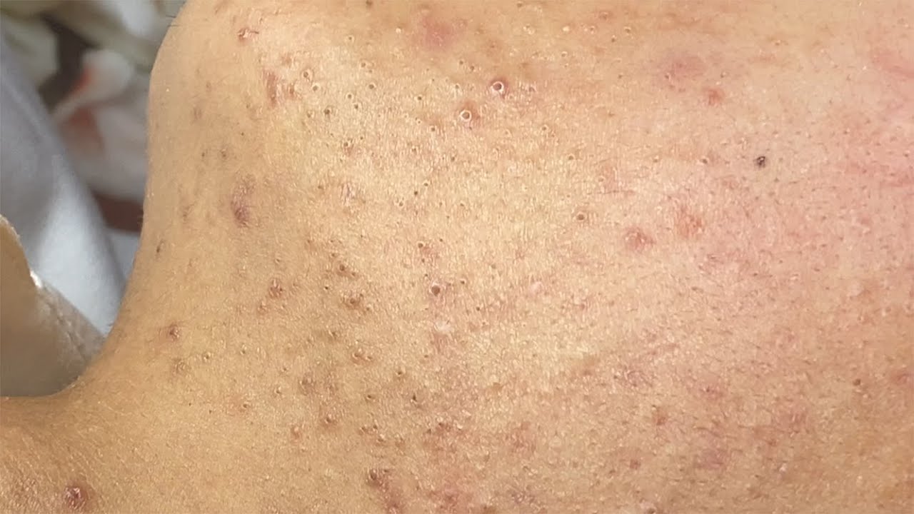 Acne Treatment at 7 District!
