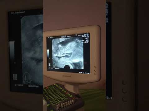 Video: Schwangerschaftsultraschall: Zweck, Verfahren Und Vorbereitung