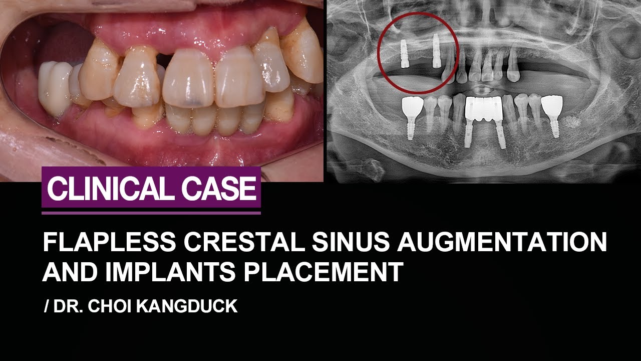 Flapless Crestal Approach Sinus Augmentation and Implant Placement YouTube