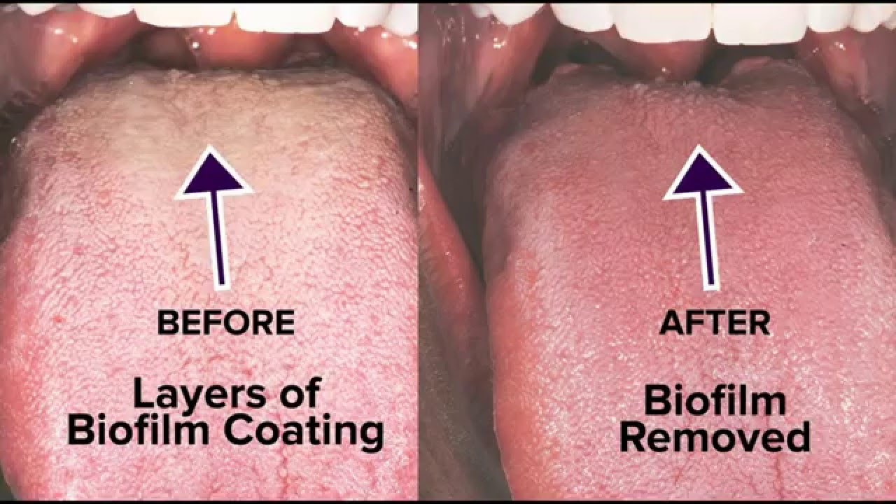 Tongue Rejuvenation The ANSWER to Fixing Chronic Bad Breath  Halitosis