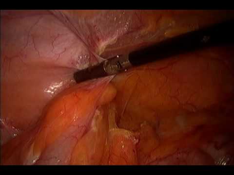 Laparoscopic Right Colectomy of Carcinomas of the Cecum and Transverse Colon