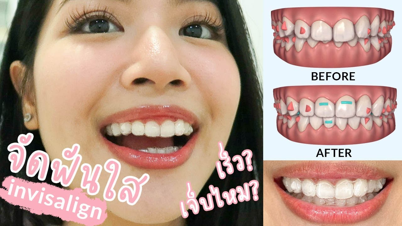 INVISALIGN JOURNEY 🦷 รีวิวละเอียด จัดฟันใส เจ็บไหม นานไหม ดูแลยังไง? | ChanyaChannel