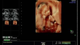 3D and 2D Baby Ultrasound: Liam @ 17weeks and 1 day old in my belly